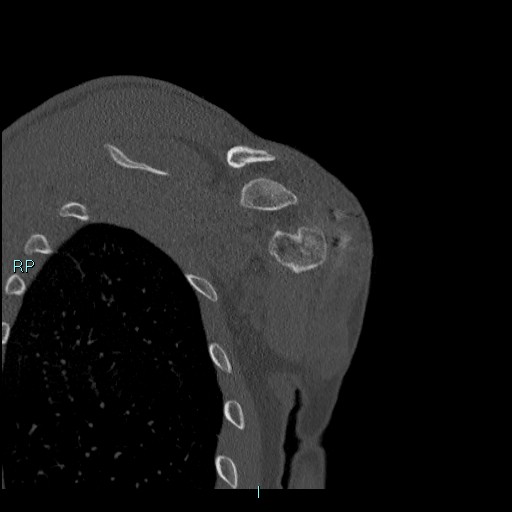 Avascular necrosis after fracture dislocations of the proximal humerus (Radiopaedia 88078-104655 Coronal bone window 104).jpg