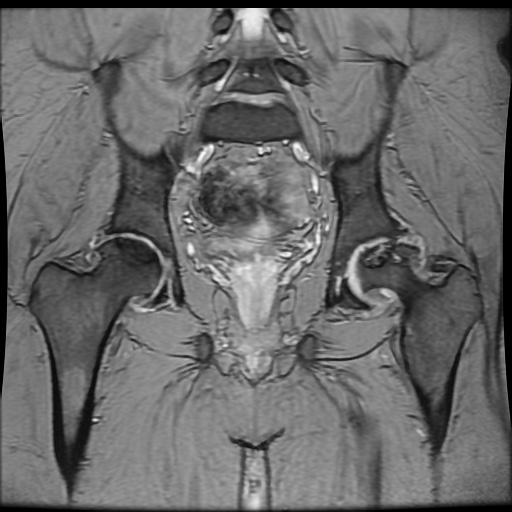 Avascular necrosis of the hip (Radiopaedia 61503-69465 F 58).jpg