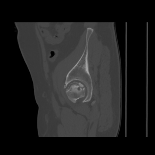 Avascular necrosis of the hip (Radiopaedia 61503-69467 B 46).jpg