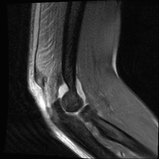 File:Avulsion of the triceps tendon (Radiopaedia 42919-46154 Sagittal PD fat sat 2).jpg