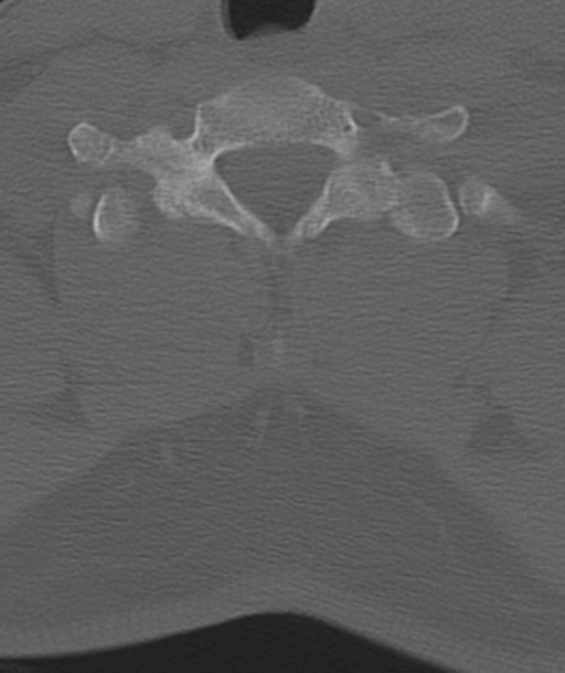 Axis peg fracture (type 3) and atlas lateral mass (type 4) fracture (Radiopaedia 37474-39324 Axial bone window 47).png