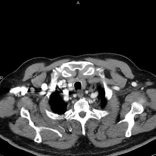 File:Azygos continuation of the inferior vena cava (Radiopaedia 18537-18404 C+ arterial phase 8).jpg
