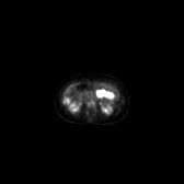 B-cell lymphoma of the mesentery (Radiopaedia 65743-74868 18F-FDG PET-CT 144).jpg