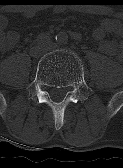 File:Baastrup syndrome (Radiopaedia 64891-73838 Axial bone window 8).jpg