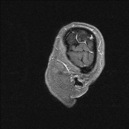 Balo concentric sclerosis (Radiopaedia 50458-55940 Sagittal T1 C+ 16).jpg