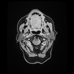 Balo concentric sclerosis (Radiopaedia 53875-59982 Axial LAVA C+ 6).jpg