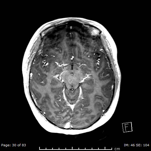 File:Balo concentric sclerosis (Radiopaedia 61637-69636 Axial T1 C+ 30).jpg