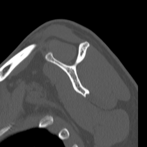 Bankart lesion (Radiopaedia 57256-64185 Sagittal bone window 38).jpg