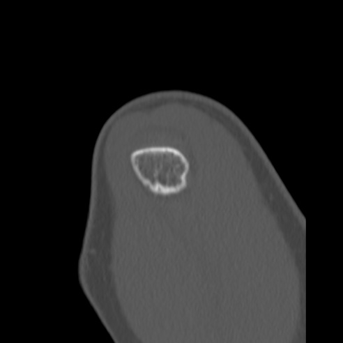 Bankart lesion (Radiopaedia 57256-64185 Sagittal bone window 5).jpg