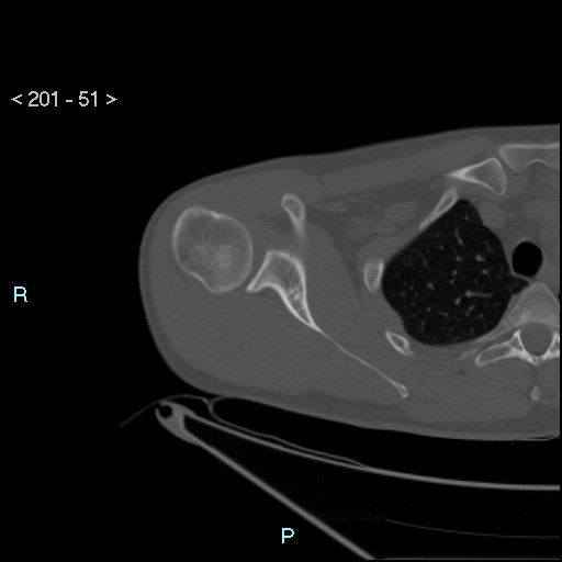 Bankart lesion with glenoid bone defect - assessment TC with PICO method (Radiopaedia 42855-93901 Axial bone window 50).jpg