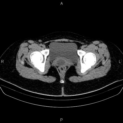 File:Bartholin gland cyst (Radiopaedia 62635-70930 Axial non-contrast 70).jpg