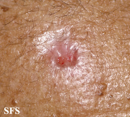Basal Cell Carcinoma (Dermatology Atlas 142).jpg