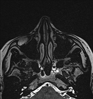 Basal cell carcinoma - nasal region (Radiopaedia 70292-80365 Axial Gradient Echo 33).jpg