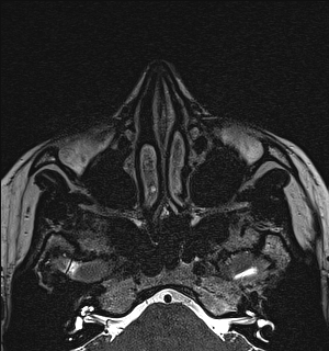 Basal cell carcinoma - nasal region (Radiopaedia 70292-80365 Axial Gradient Echo 39).jpg