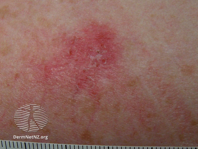 Basal cell carcinoma affecting the face (DermNet NZ lesions-bcc-face-0796).jpg