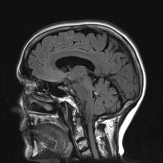 File:Base of skull chondrosarcoma (Radiopaedia 30410-31070 Sagittal FLAIR 13).jpg