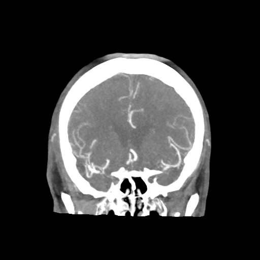 Basilar and bilateral vertebral artery occlusion (Radiopaedia 45592-49723 B 38).png