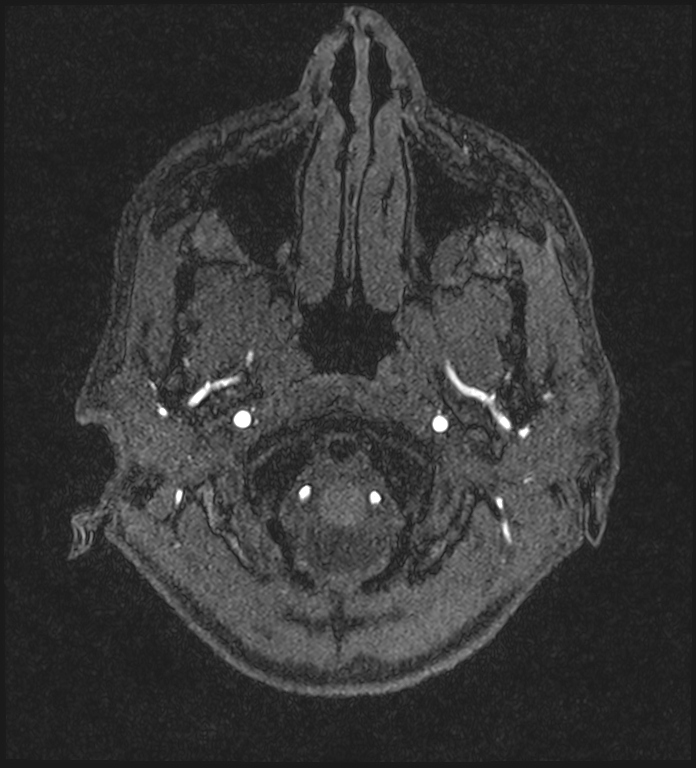 Basilar artery perforator aneurysm (Radiopaedia 82455-97733 Axial MRA 15).jpg