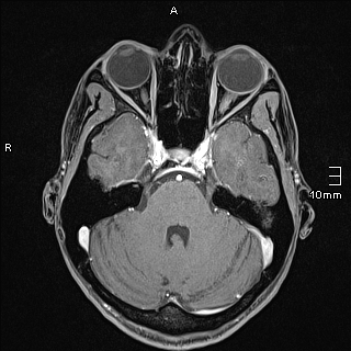 Basilar artery perforator aneurysm (Radiopaedia 82455-99523 G 37).jpg