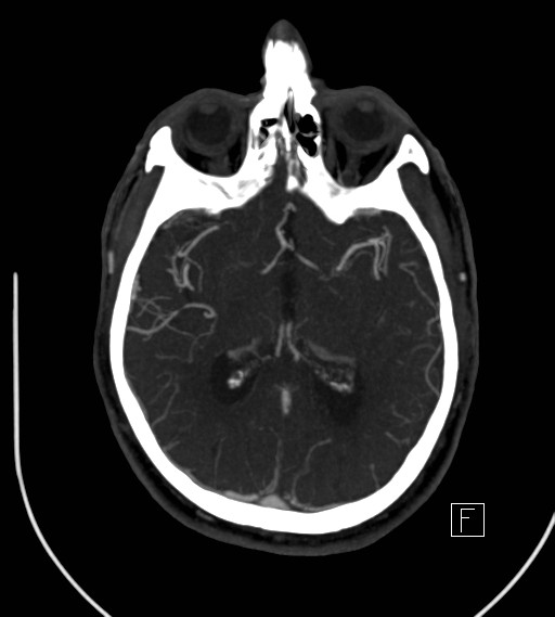 Basilar artery thrombosis (Radiopaedia 26986-27163 A 46).jpg