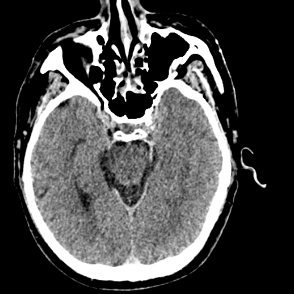 Basilar artery thrombosis (Radiopaedia 53351-59333 Axial non-contrast 52).jpg