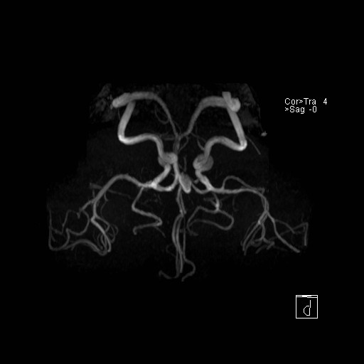 Basilar tip aneurysm (Radiopaedia 26504-26632 D 14).jpg