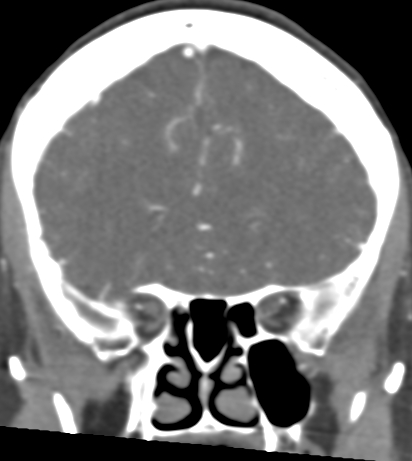 Basilar tip aneurysm with coiling (Radiopaedia 53912-60086 B 42).jpg