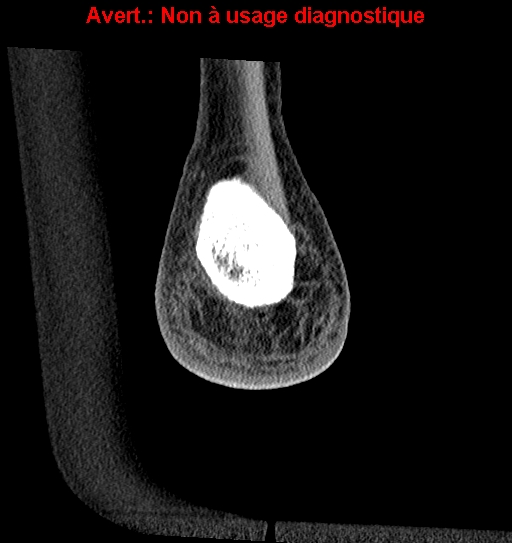 Baxter neuropathy (Radiopaedia 25988-26125 Coronal non-contrast 54).jpg