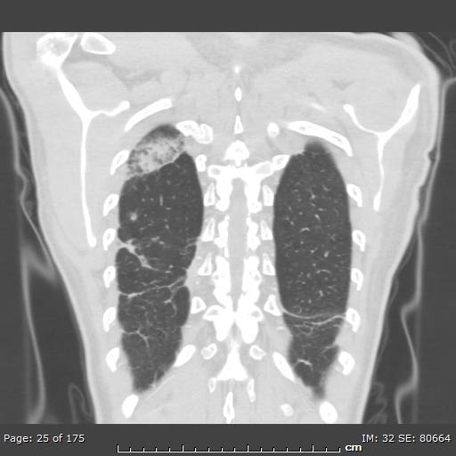Behçet disease (Radiopaedia 44247-47889 Coronal lung window 3).jpg