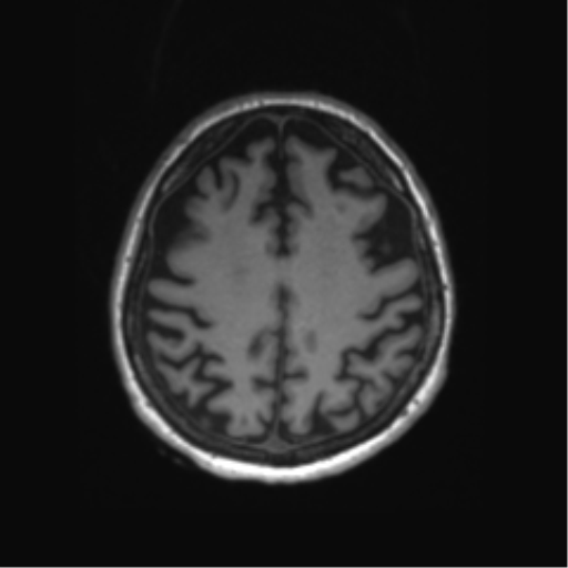 Behavioral variant frontotemporal dementia and late onset schizophrenia (Radiopaedia 52197-58083 Axial T1 22).png