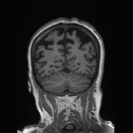File:Behavioral variant frontotemporal dementia and late onset schizophrenia (Radiopaedia 52197-58083 Coronal T1 28).png