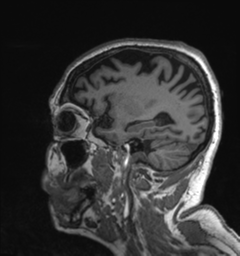 Behavioral variant frontotemporal dementia and late onset schizophrenia (Radiopaedia 52197-58083 Sagittal T1 19).png