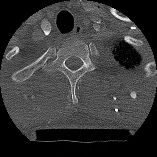 Benign post-traumatic pseudopneumoperitoneum (Radiopaedia 71199-81495 Axial bone window 34).jpg