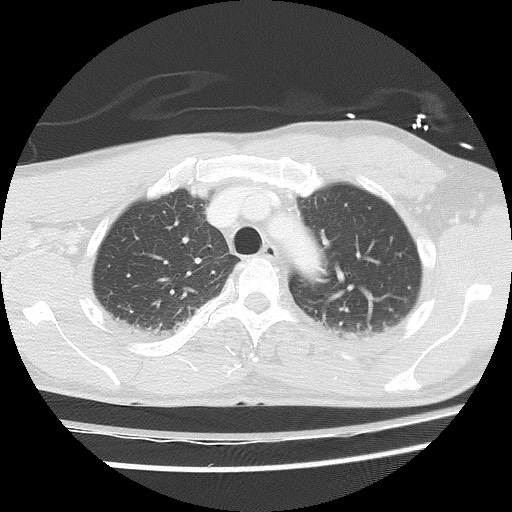 Benign post-traumatic pseudopneumoperitoneum (Radiopaedia 71199-81495 Axial lung window 24).jpg