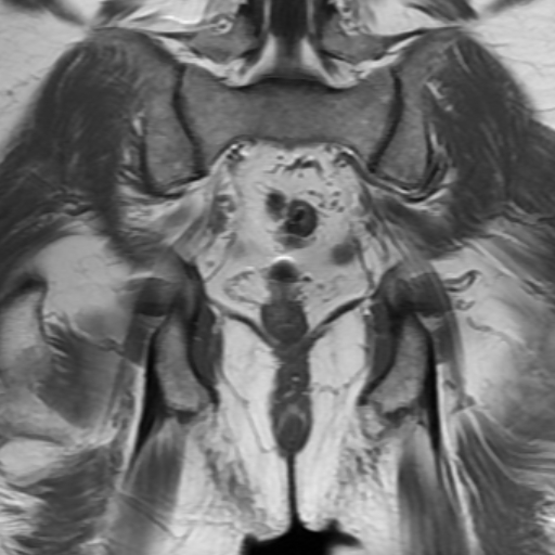 File:Benign prostatic nodular hyperplasia (Radiopaedia 16917-16634 Coronal T1 16).jpg