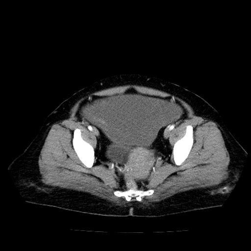 File:Benign spindle cell tumor - abdominopelvic (Radiopaedia 61300-69212 A 52).jpg