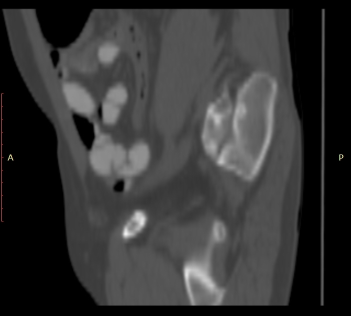 Bertolotti syndrome (Radiopaedia 58974-66235 Sagittal bone window 52).jpg