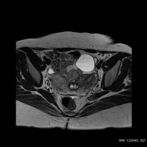File:Bicornuate uterus- on MRI (Radiopaedia 49206-54297 Axial T2 8).jpg