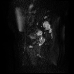 File:Bicornuate uterus (Radiopaedia 51676-57472 Sagittal DWI 44).jpg