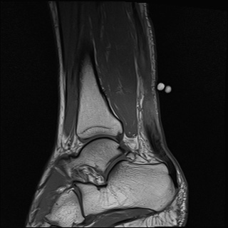 File:Bilateral Achilles tendon complete tear (Radiopaedia 81344-95051 Sagittal T1 25).jpg