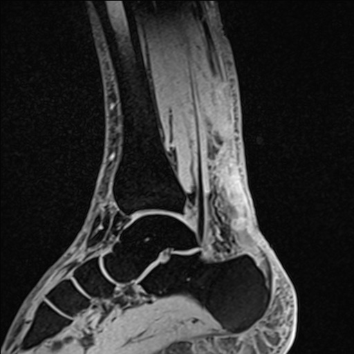 Bilateral Achilles tendon complete tear (Radiopaedia 81344-95051 Sagittal WE - Left 51).jpg