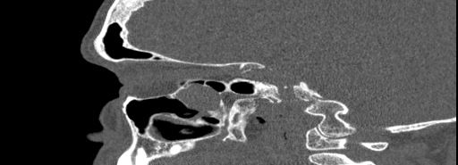 Bilateral Ectopic Infraorbital Nerves (Radiopaedia 49006-54084 Sagittal bone window 20).jpg