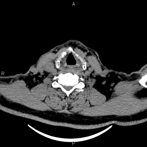 Bilateral Warthin tumors (Radiopaedia 84034-99263 Axial non-contrast 43).jpg