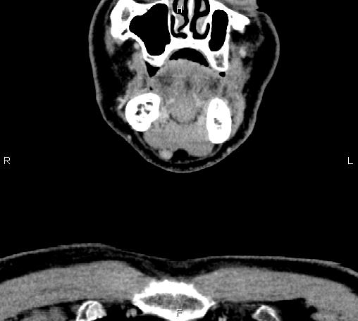 File:Bilateral Warthin tumors (Radiopaedia 84034-99263 C 7).jpg