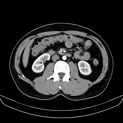 Bilateral accessory renal arteries with mild pelvi-ureteric junction (PUJ) obstruction (Radiopaedia 66357-75596 A 28).jpg