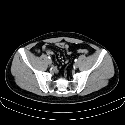 Bilateral accessory renal arteries with mild pelvi-ureteric junction (PUJ) obstruction (Radiopaedia 66357-75596 A 55).jpg