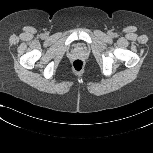 Bilateral acetabular protrusion with pincer type femoro-acetabular impingement (Radiopaedia 30134-30733 AXIAL SOFT THIN 73).jpg