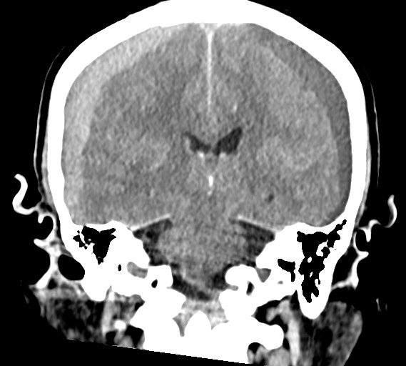 Bilateral acute on chronic subdural hematomas (Radiopaedia 78466-91146 Coronal non-contrast 42).jpg