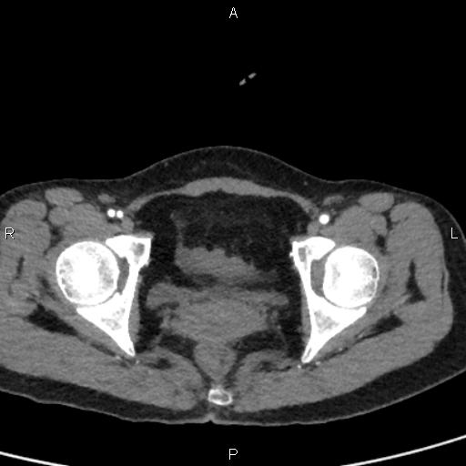 Bilateral adrenal gland hyperenhancement in pancreatitis (Radiopaedia 86642-102753 B 119).jpg