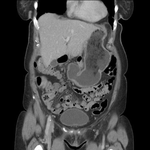 Bilateral adrenal granulocytic sarcomas (chloromas) (Radiopaedia 78375-91007 B 30).jpg